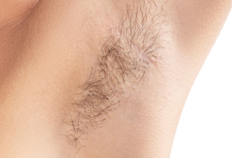 Before the Laser Hair Removal procedure