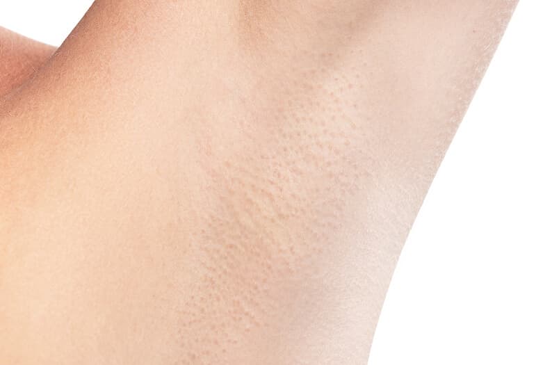 After the Laser Hair Removal procedure