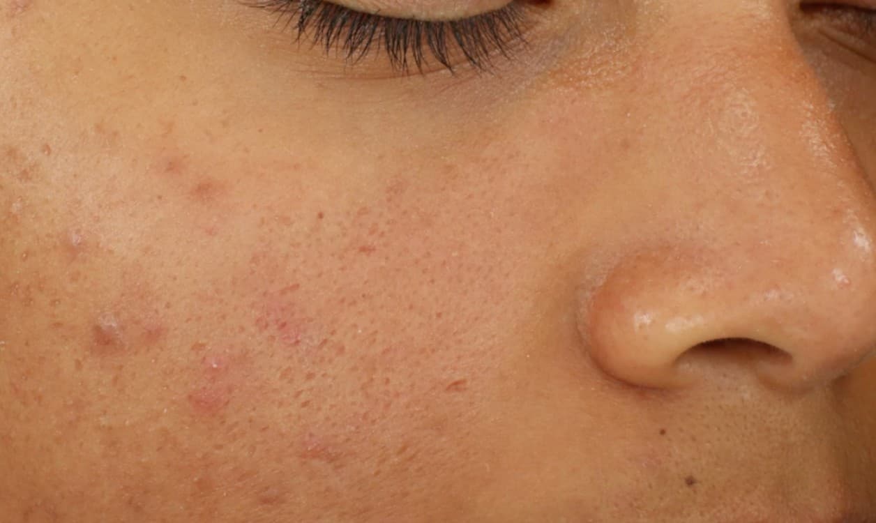 Before the Medical-Grade Facial procedure