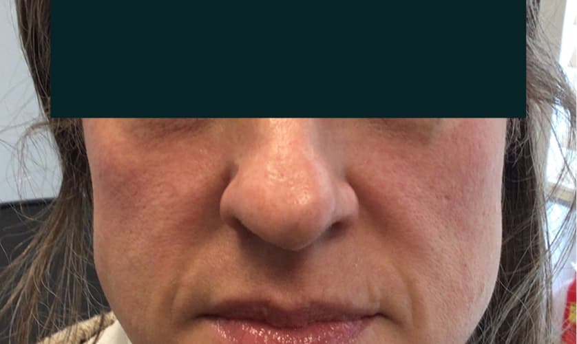 Before the CO2 Laser Resurfacing procedure