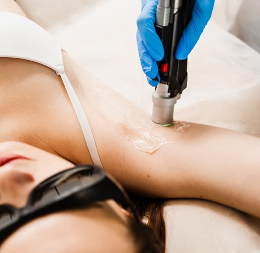 Laser hair removal treatment on the underarm